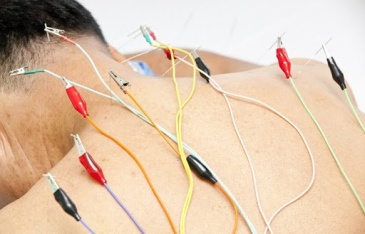 Điện châm là gì? Những điều cần biết về phương pháp điện châm